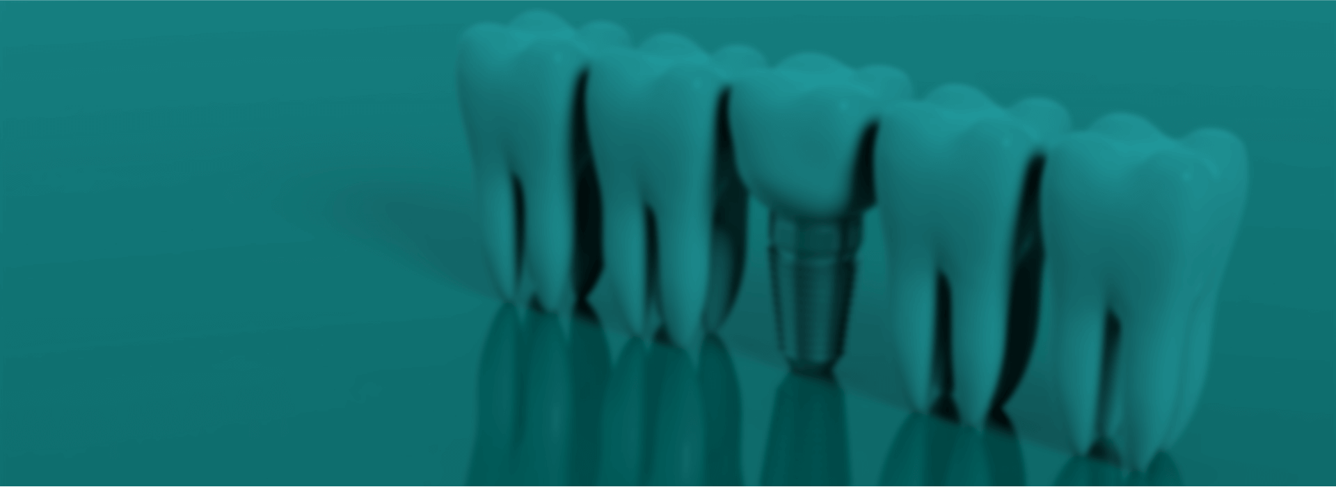 implantes dentários slide